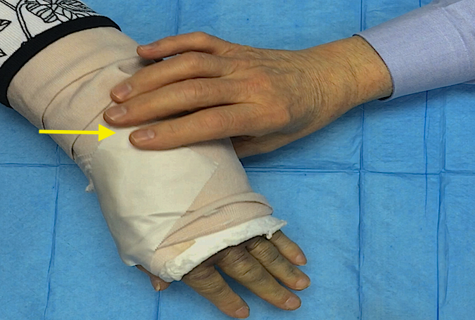 Fracture Crepitus, Deformity, Motion and Tenderness | Hand Surgery Resource